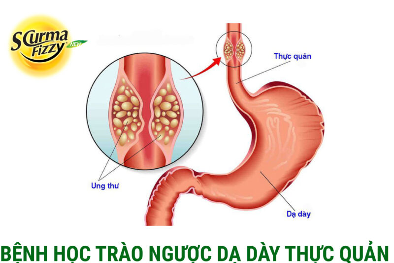 Benh-hoc-trao-nguoc-da-day-thuc-quan