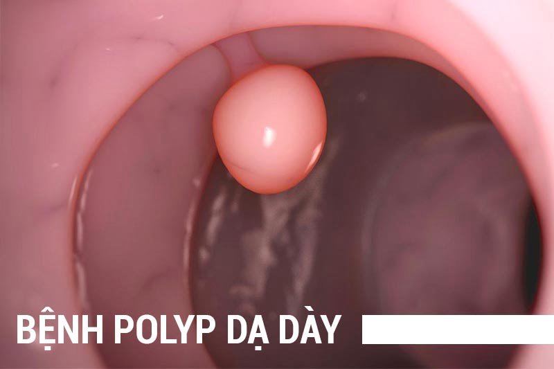 polyp-da-day-1