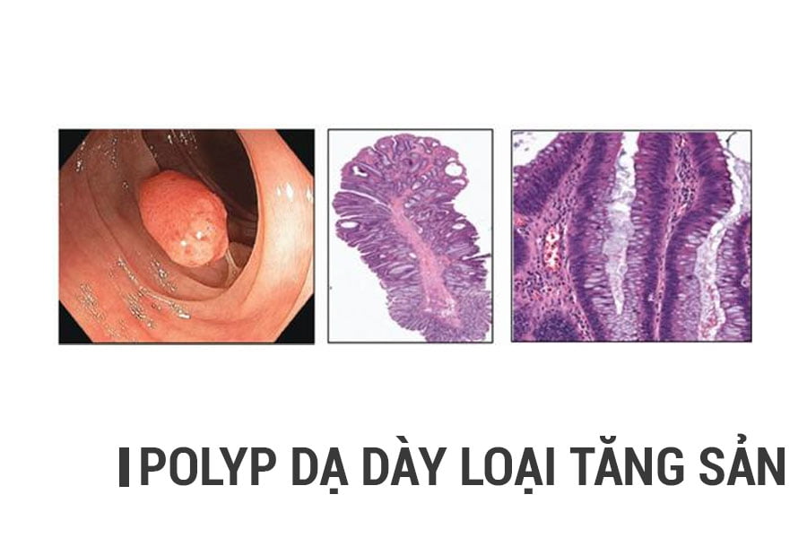 polyp-da-day-tang-san