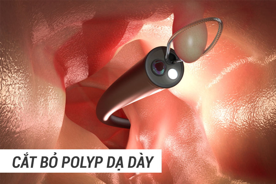 cat-bo-polyp-da-day