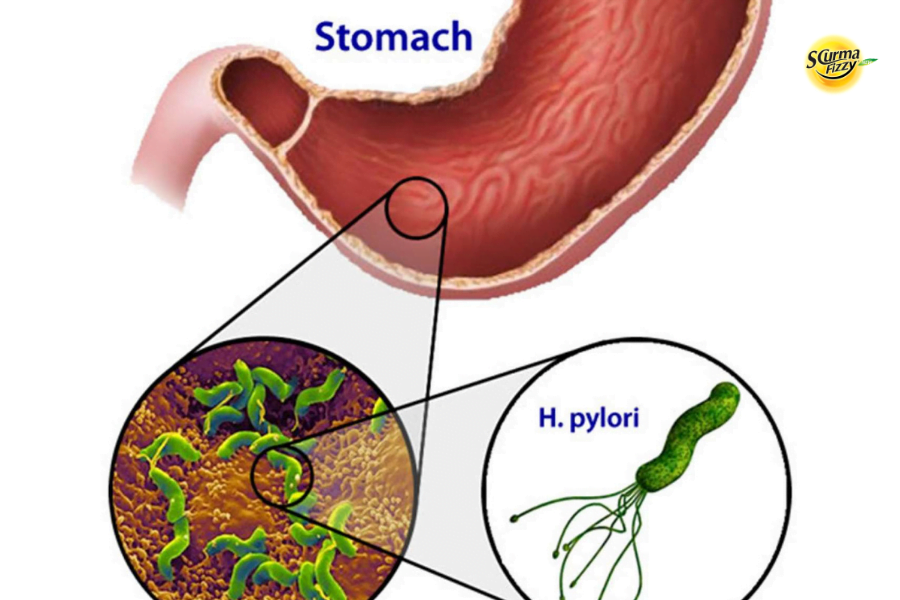 Vi khuẩn HP ở dạ dày gây bệnh như thế nào?