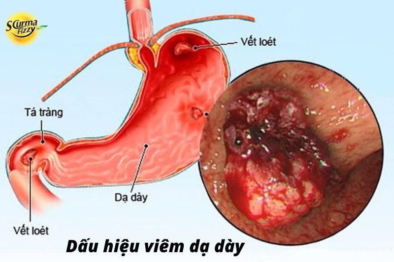 Dấu hiệu viêm dạ dày
