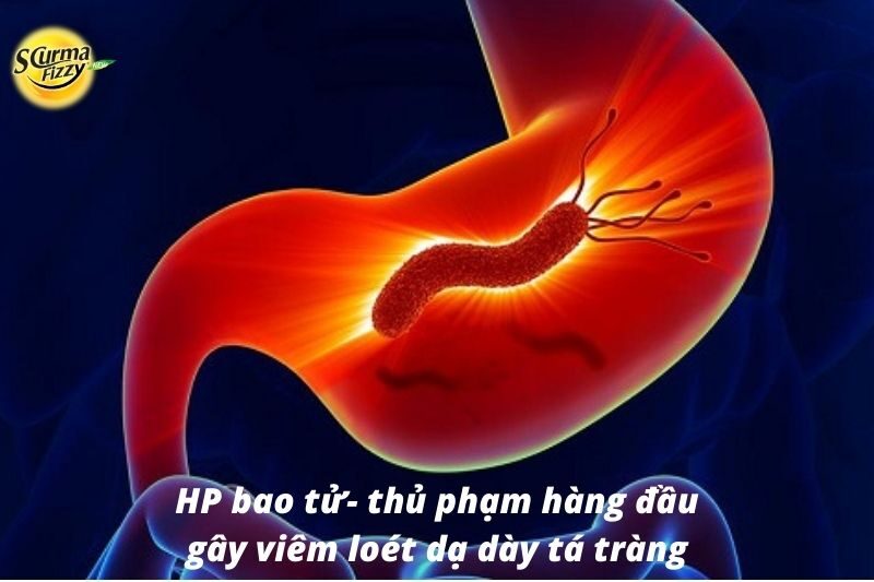 HP bao tử- thủ phạm hàng đầu gây viêm loét dạ dày tá tràng