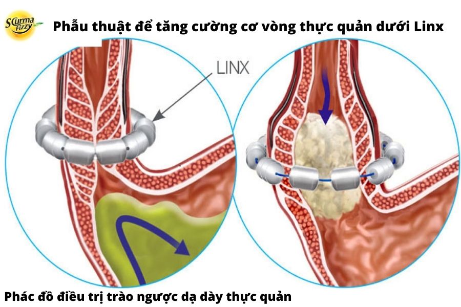 phẫu thuật để tăng cường cơ vòng thực quản dưới Linx