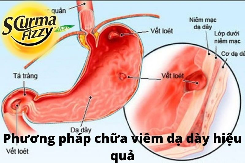 phuong-phap-chua-viem-da-day-hieu-qua