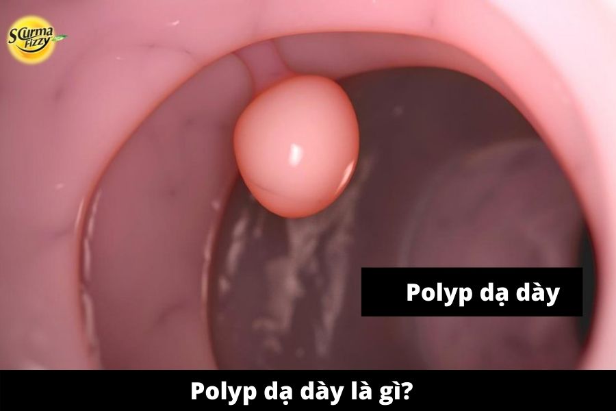 Polyp-da-day-la-gi-1