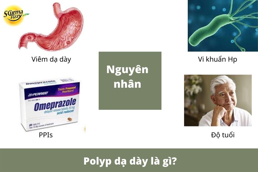 Polyp-da-day-la-gi-2