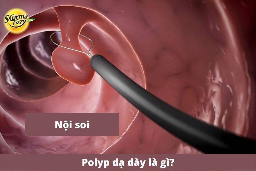 Polyp-da-day-la-gi-5