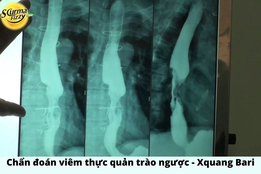 X - quang bari