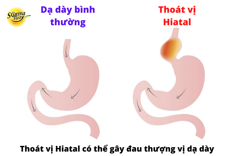 dau-thuong-vi-da-day (3)
