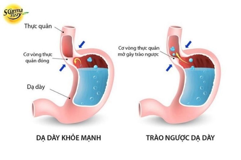 trieu-chung-benh-trao-nguoc-da-day