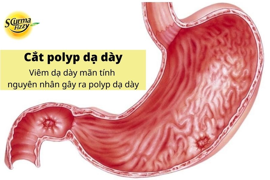 Viêm dạ dày mãn tính nguyên nhân của polyp dạ dày