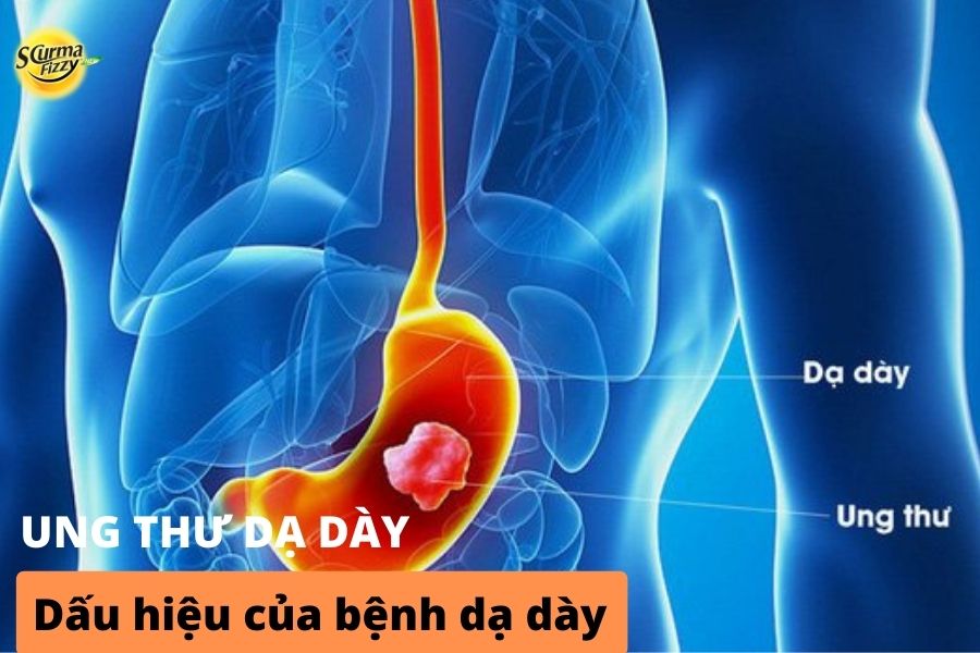 ung-thu-da-day-5