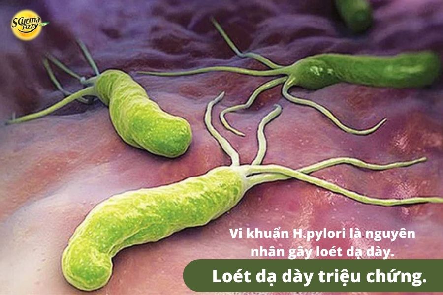 Vi khuẩn H.pylori là nguyên nhân gây loét dạ dày.
