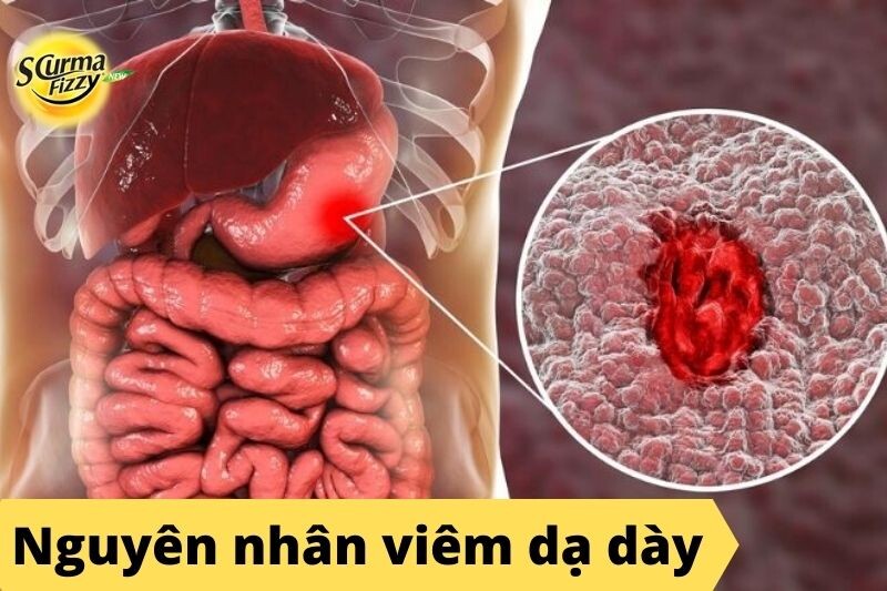 nguyen-nhan-viem-da-day