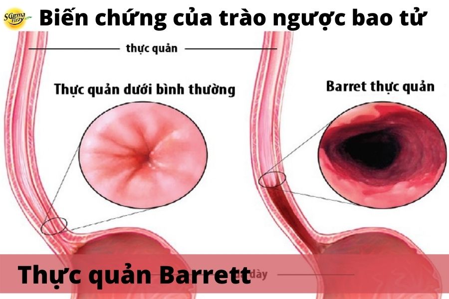 biến chứng barrett