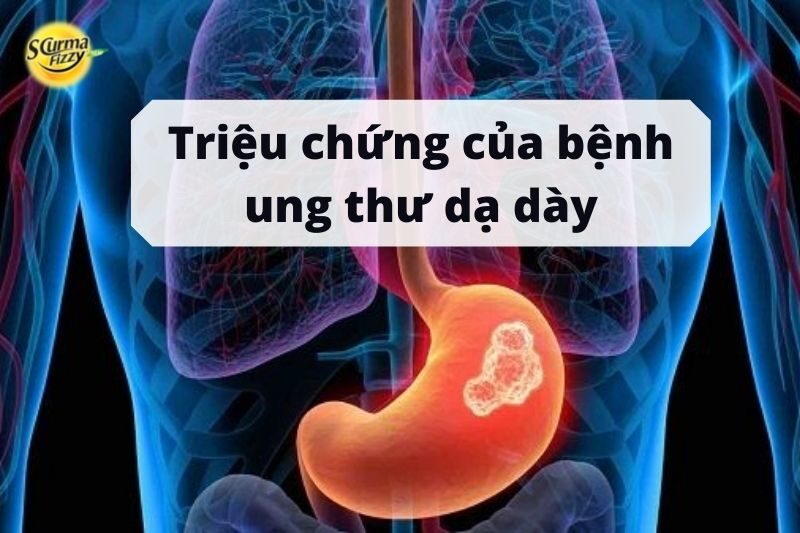 Triệu chứng của bệnh ung thư dạ dày