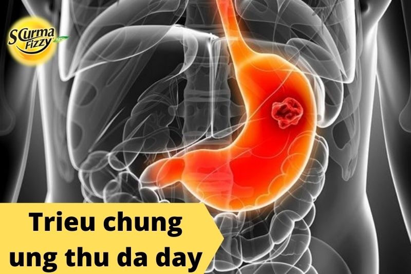 trieu-chung-ung-thu-da-day