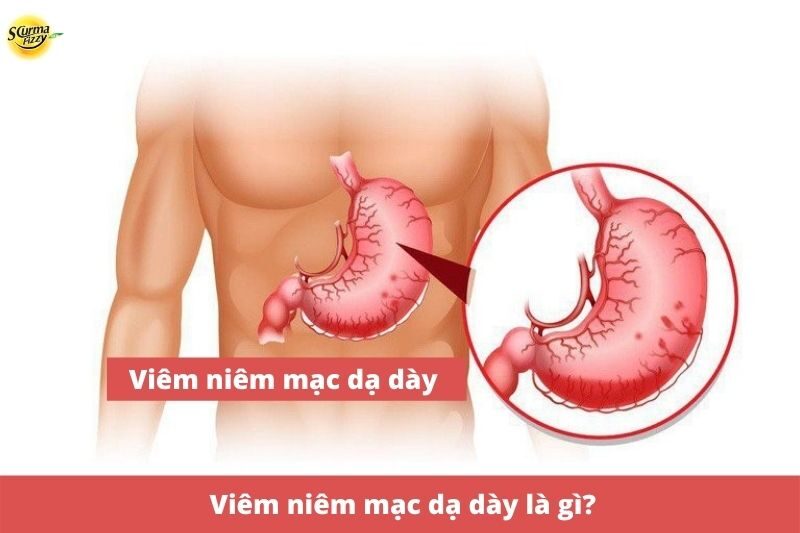 viem-niem-mac-da-day-la-gi-anh-dai-dien
