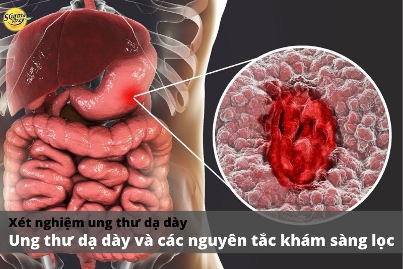 xét-nghiệm-ung-thư-dạ-dày1