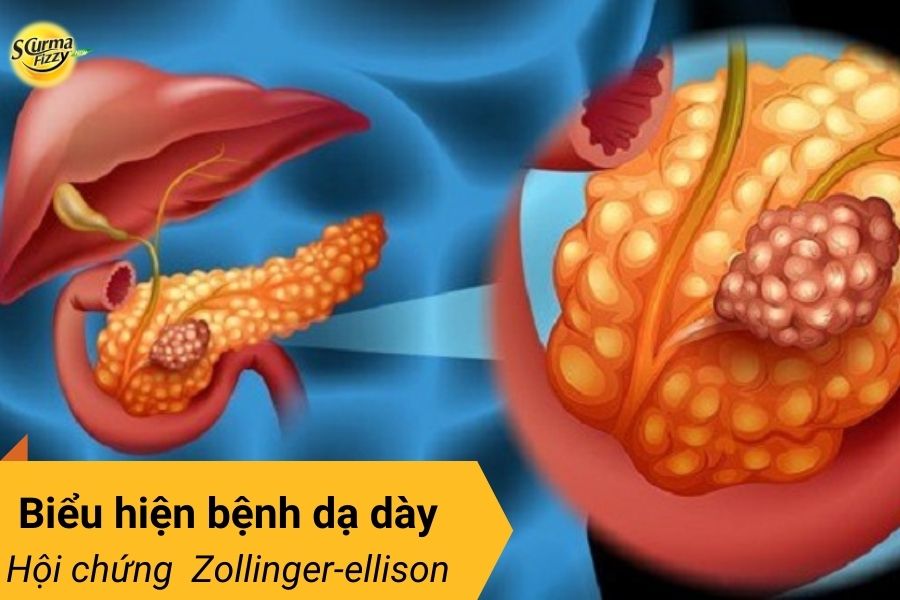 Hội chứng Zollinger-ellison