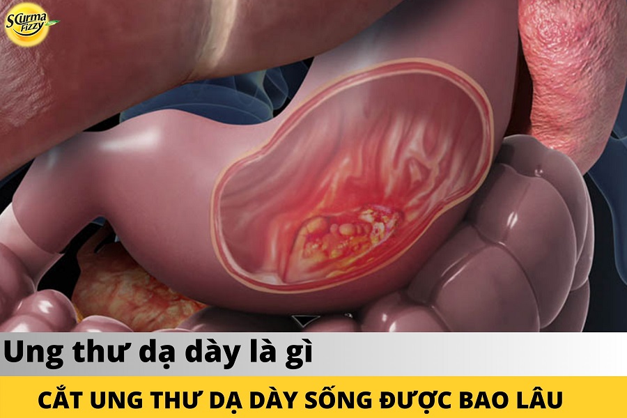 cat-ung-thu-da-day-song-duoc-bao-lau-1.