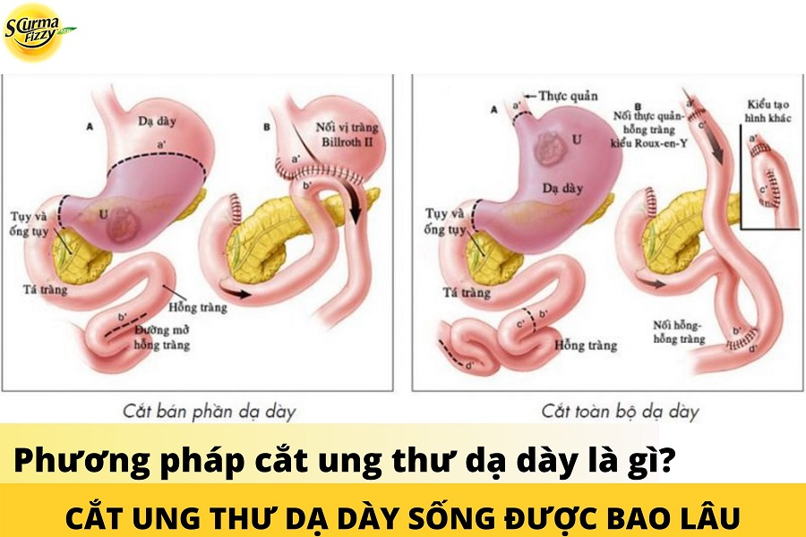 cat-ung-thu-da-day-song-duoc-bao-lau-12