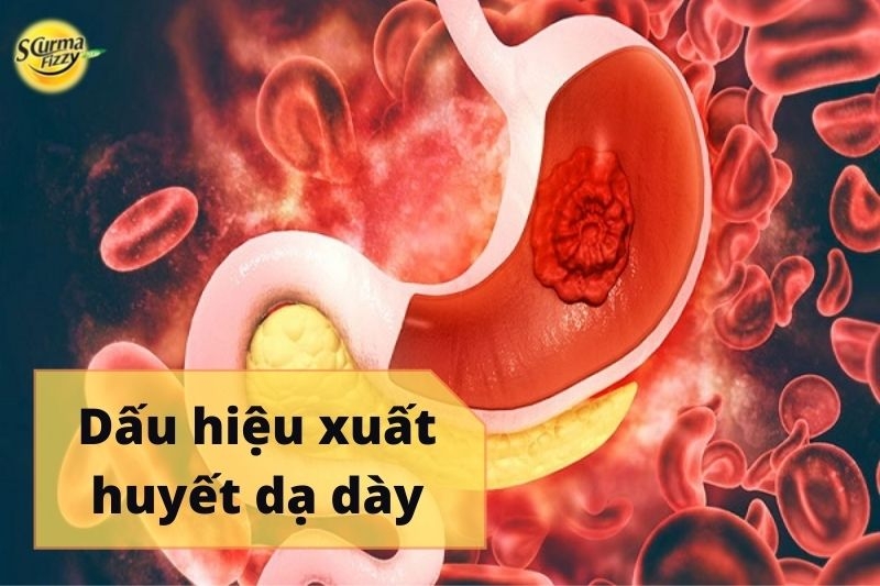 Dấu hiệu xuất huyết dạ dày