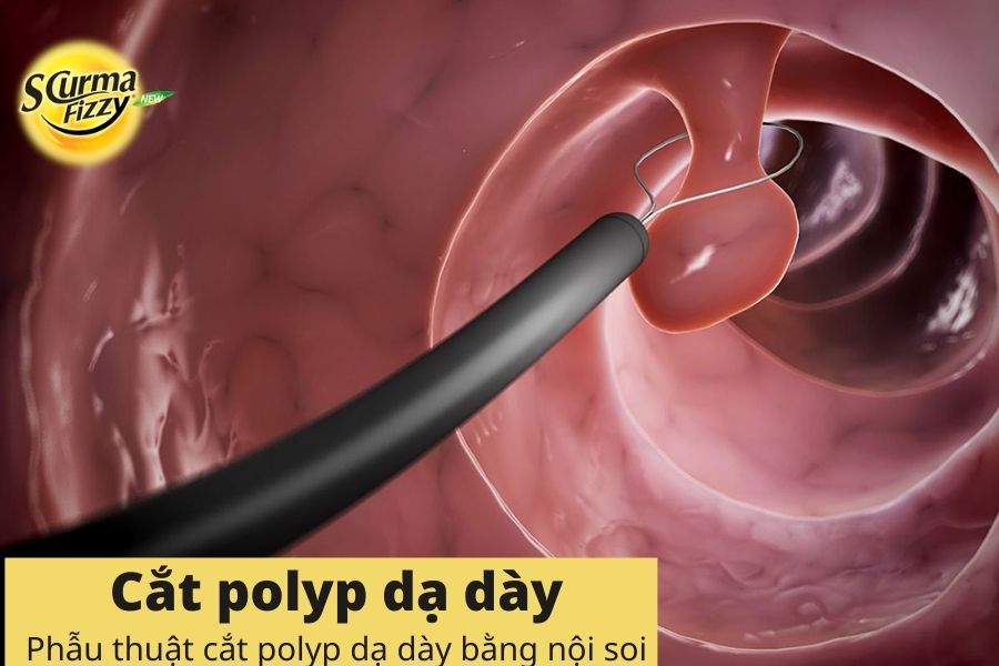Cắt bỏ polyp dạ dày khi nội soi