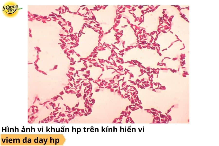 Nhuộm soi vi khuẩn HP trên kính hiển vi