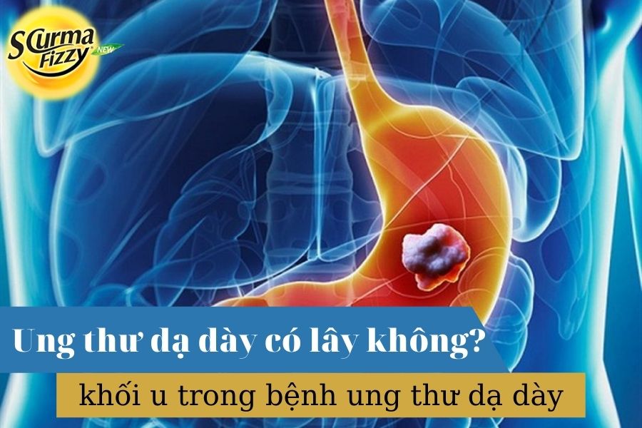 ung-thu-da-day-co-lay-khong-1